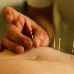 Acupuncture1